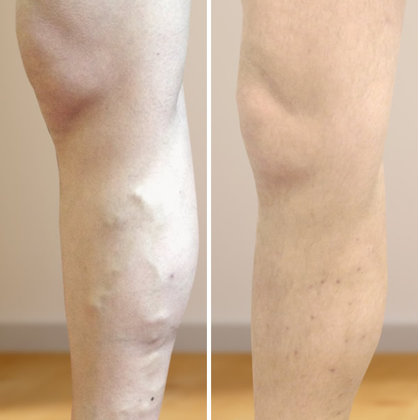 Visszérműtét előtt és után - galéria - Dr. Sepa György érsebész - A visszér eltávolítása után fotó