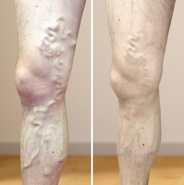 visszér és vénák visszér a lábak a betegségről