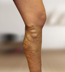 fotó a lábak varikózisáról