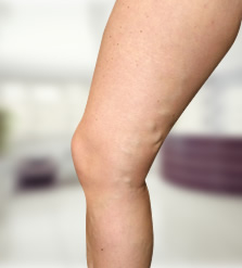 Visszér a lábakban férfiaknál: okok, tünetek, kezelés