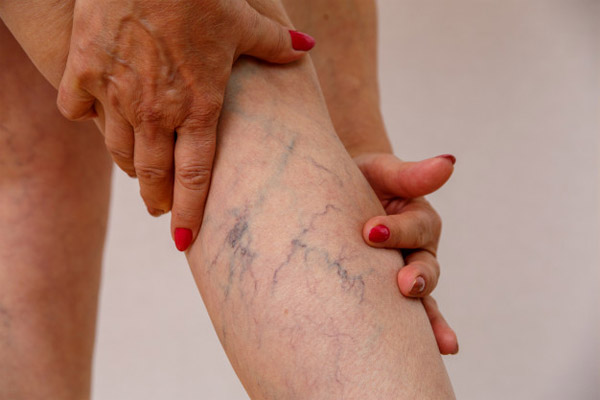 a keringési rendszer betegségei visszér hogyan lehet megbirkózni a visszerek a lábakon